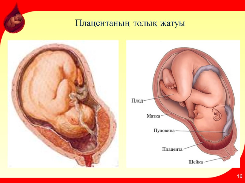 Плацентаның толық жатуы 16